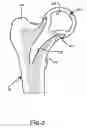 Fig. 06 - Hip joint prosthesis