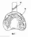 Fig. 02 - Orthodontic Repositioning Applicance