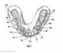 Fig. 08 - Orthodontic Repositioning Applicance