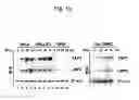 Fig. 02 - Detection of uterine leiomyosarcoma using LMP2