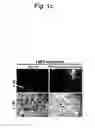 Fig. 04 - Detection of uterine leiomyosarcoma using LMP2