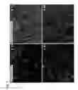 Fig. 07 - Detection of uterine leiomyosarcoma using LMP2