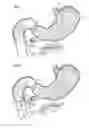 Fig. 02 - Pancreatic exocrine secretion diversion apparatus and method
