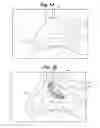 Fig. 02 - Devices and methods for minimally invasive access to sinuses and treatment of sinusitis
