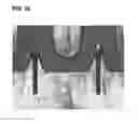 Fig. 16 - STRUCTURE OF MICRO-NEEDLE WITH SIDE CHANNEL AND MANUFACTURING METHOD THEREOF