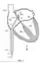 Fig. 03 - Patent foramen ovale catheter and method of using the same