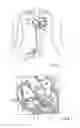 Fig. 02 - Irrigated catheter and method, in particular for ablation and like techniques