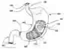 Fig. 01 - Bioerodible self-deployable intragastric implants