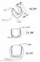 Fig. 09 - Bioerodible self-deployable intragastric implants