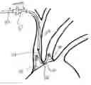 Fig. 01 - Dual endovascular filter and methods of use