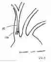 Fig. 06 - Dual endovascular filter and methods of use