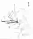 Fig. 17 - Systems and methods for facet joint treatment