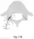 Fig. 20 - Systems and methods for facet joint treatment