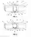 Fig. 02 - DEVICE FOR FASTENING POST-CRANIOTOMY BONE FLAPS