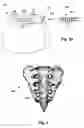 Fig. 03 - Systems and methods for anchoring leads of electrical stimulation systems in and around bony structures
