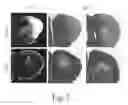 Fig. 02 - Endothelial monocyte activation polypeptide II, a biomarker for use in diagnosis and treatment of brain injury