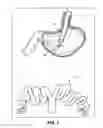 Fig. 02 - Peroral transgastric endoscopic techniques