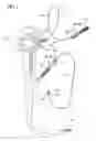 Fig. 02 - Treatment tool
