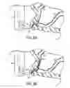 Fig. 08 - Methods and apparatuses for endoscopic retrograde cholangiopancreatography
