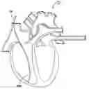 Fig. 01 - Implantable Pressure Sensor with Membrane Bridge