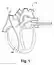 Fig. 02 - Implantable Pressure Sensor with Membrane Bridge