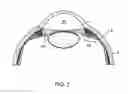 Fig. 03 - Glaucoma treatment device