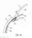 Fig. 17 - Glaucoma treatment device