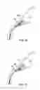 Fig. 19 - Glaucoma treatment device