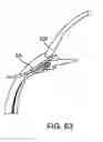 Fig. 41 - Glaucoma treatment device