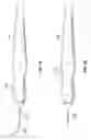 Fig. 06 - Ocular implant with stiffness qualities, methods of implantation and system