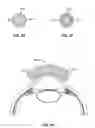 Fig. 08 - Ocular implant with stiffness qualities, methods of implantation and system