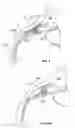 Fig. 11 - Ocular implant with stiffness qualities, methods of implantation and system