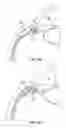 Fig. 12 - Ocular implant with stiffness qualities, methods of implantation and system