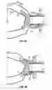 Fig. 04 - Conduit device and system for implanting a conduit device in a tissue wall