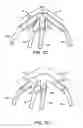 Fig. 12 - Medical retrieval device with frangible basket