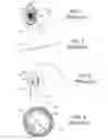 Fig. 02 - Anterior capsulotomy device and procedure