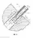 Fig. 06 - Dual hypotube suture cutting device and methods