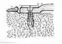 Fig. 01 - Elastic tissue closure with elastic staple