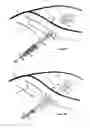 Fig. 37 - Elastic tissue closure with elastic staple