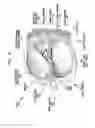 Fig. 04 - BIMODAL HEARING PROSTHESIS