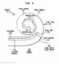 Fig. 09 - BIMODAL HEARING PROSTHESIS