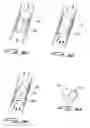 Fig. 35 - Vascular device with valve for approximating vessel wall
