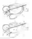 Fig. 20 - Elongated body for deployment in a heart