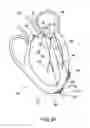 Fig. 22 - Elongated body for deployment in a heart