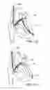 Fig. 32 - Elongated body for deployment in a heart