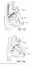 Fig. 33 - Elongated body for deployment in a heart