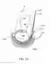 Fig. 34 - Elongated body for deployment in a heart