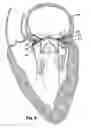 Fig. 05 - Heart valve prosthesis and method of implantation thereof