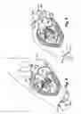 Fig. 07 - Heart valve prosthesis and method of implantation thereof