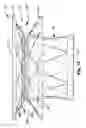 Fig. 10 - Heart valve prosthesis and method of implantation thereof